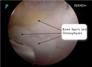 Ulnohumeral Arthroplasty: Before