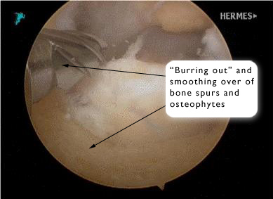 Ulnohumeral Arthroplasty: After Ulnohumeral Arthroplasty: After